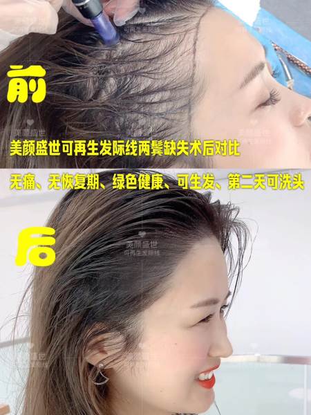再生發(fā)效果對比一